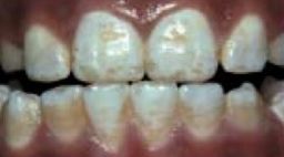 Dental-Fluorosis-Framed.jpg