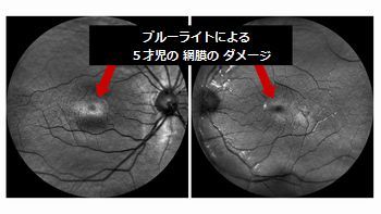 retina damage 5yearsold.jpg